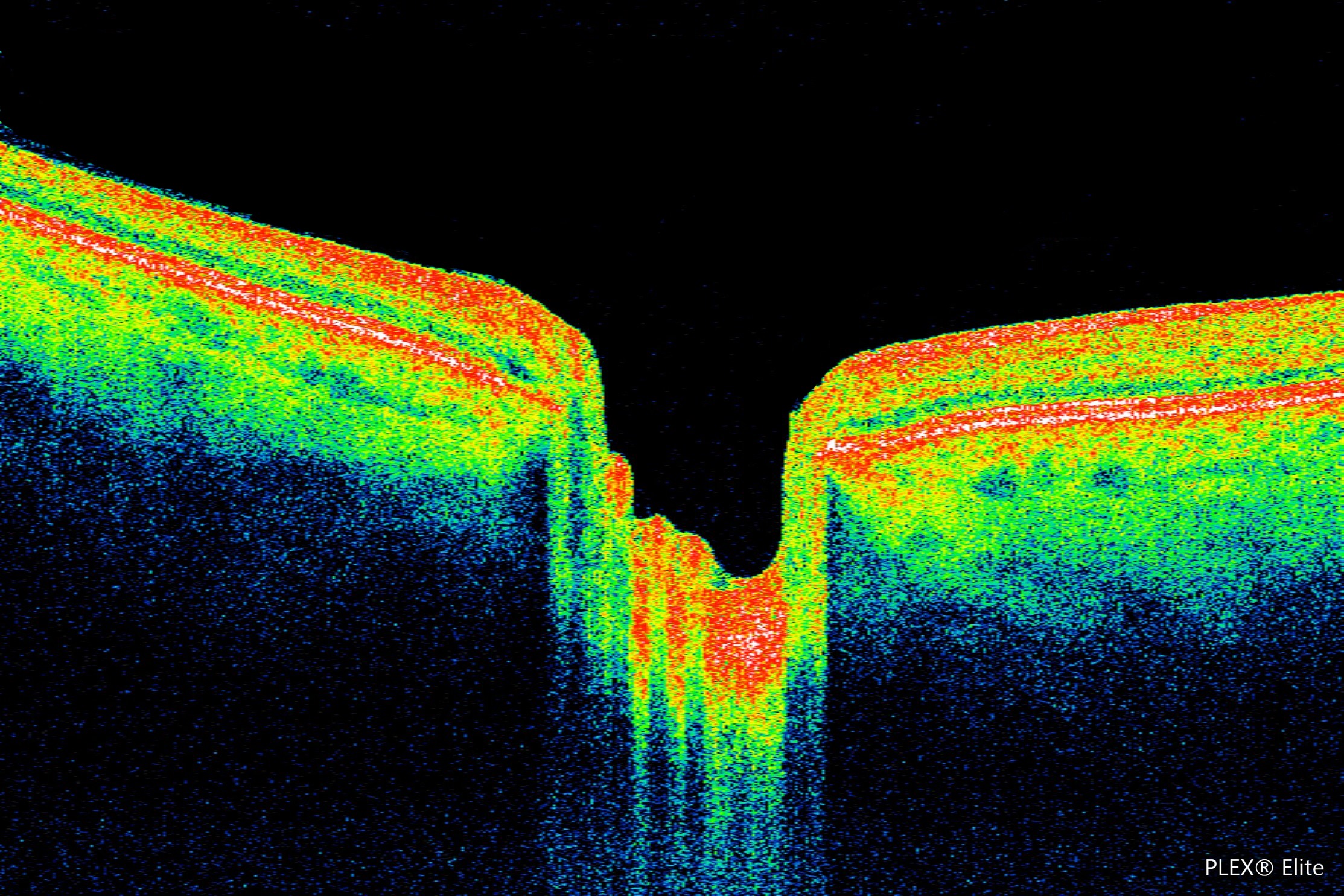 OCT image of the retina
